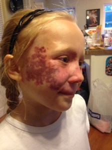 Addy dappled after surgery