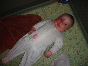 Addy Wired Port Wine Stain Baby