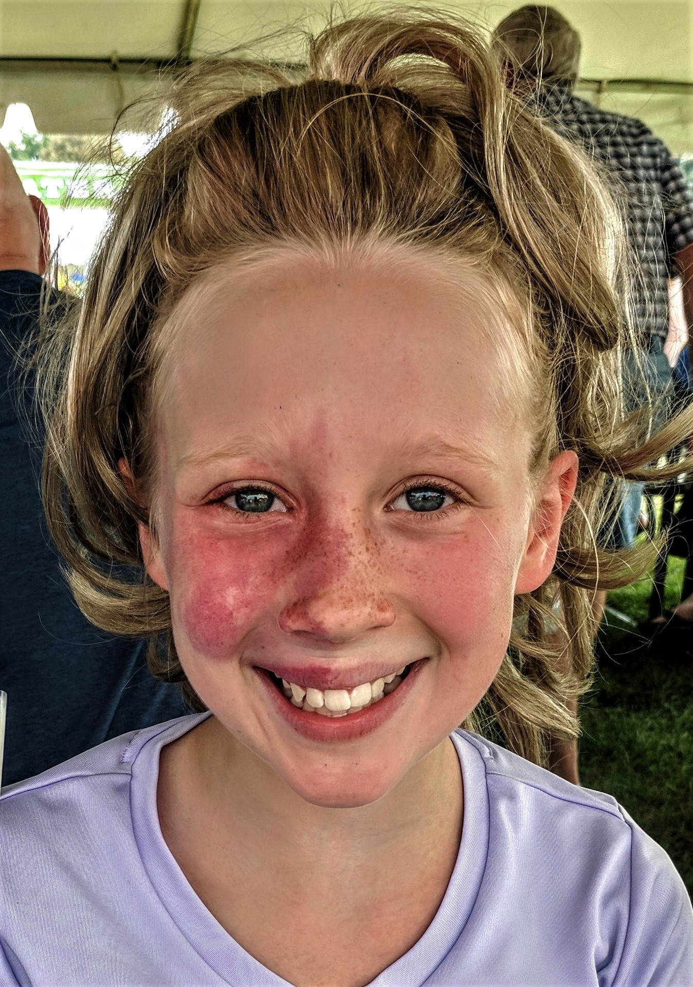 Addy_Port_wine_stain_at_fair